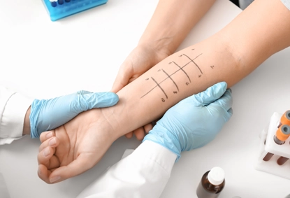 Skin Prick Allergy Test: How It Helps Diagnose Your Allergies